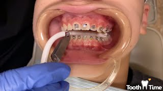 How braces are put on  12 year old patient  Tooth Time Family Dentistry New Braunfels [upl. by Notgnimer108]