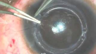 Intacs Insertion for Keratoconus [upl. by Thrasher]