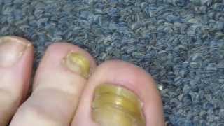 My Toenail Fungus Sucess Story [upl. by Sllew866]