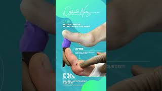 Hallux Limitus  Arthritic big toe joint [upl. by Naloj151]