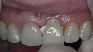 Cementation Glass ionomer cements [upl. by Knox]