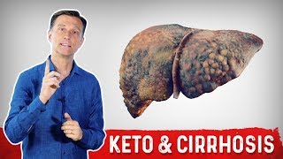 Can Keto Ketogenic Diet Help Cirrhosis of the Liver [upl. by Nodnol]