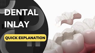 What is a Dental Inlay Quickly Explained in a Few Seconds [upl. by Christianity]