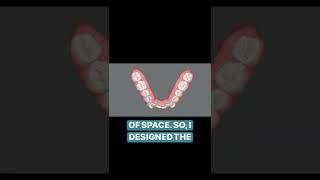 How we solve this patient’s main concern of overcrowding with Invisalign [upl. by Amerigo433]