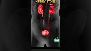 Kidney stone 🪨youtubeshorts ytshorts trendingshorts newvideo [upl. by Maible]