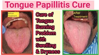 Tongue infectionGlossitis how to cure Fungal infection inside mouthTongue burning sensation cure [upl. by Nosneb]