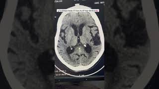 A Glimpse Inside CT Scan of a 97YearOld Brain 🧠 medical ctscan radiology neurology medicine [upl. by Epotimet]