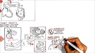 PULMONARY WEDGE PRESSURE USMLE step 1 [upl. by Nednyl]