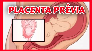 Comprendre le placenta previa [upl. by Yate]