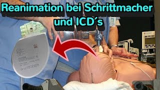 3 WICHTIGSTEN Fakten zu Reanimationen mit Schrittmachern oder ICD´s [upl. by Aselehc929]