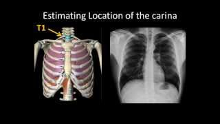 Basic Chest Radiology ET Tube Position and Complications [upl. by Muller]