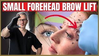 How To Perform a Botox Brow lift on a small forehead [upl. by Acinhoj80]