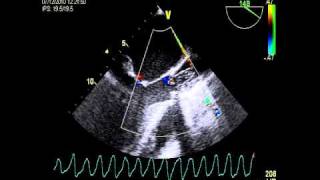 Cardiac arrest VENTRICULAR FIBRILLATION DURING TOE [upl. by Ilat]