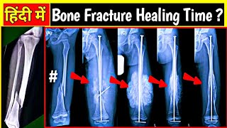 Fracture Bone Healing Process in Hindi \ फ्रैक्चर हड्डी कितने दिनों में जुड़ती है  Uday X Ray [upl. by Leahey]