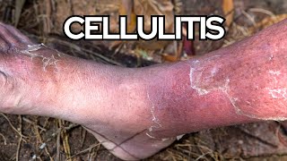 Understanding Cellulitis in Seniors Risks Complications and Prevention Strategies [upl. by Lednahc]