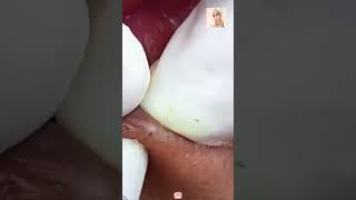 Blackheads Removal  Acne Treatment and Very Satisfying Satisfying Pimple pop blackheads [upl. by Annohsal]