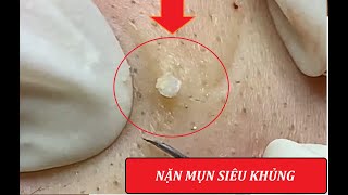 Giant blackheads amp Severe cystic acne squeezed 4  Loan Nguyen [upl. by Llevrac976]