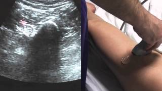 Ultrasound Guided Anterior Sciatic Nerve Block  SSRAUSAcom [upl. by Maguire]