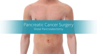 Distal Pancreatectomy How the Procedure Is Performed [upl. by Gnagflow]