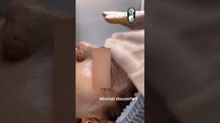 COSMELANstrongest depigmentation peel [upl. by Akemhs]