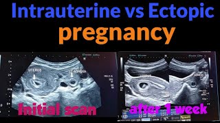 intrauterine vs ectopic pregnancy presentation I early pregnancy scan I urdu I hindi [upl. by Alenas]