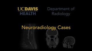 Posterior reversible encephalopathy syndrome PRES [upl. by Ojeitak309]