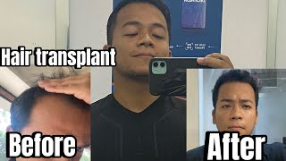 Hair transplant time lapse  Hair transplant before and after [upl. by Yesmar]