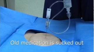 Intrathecal or Spinal Morphine pump or Baclofen pump refill procedure [upl. by Minne]