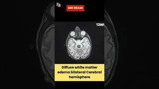 White Matter Edema ll Cerebral Edema ll Vasogenic ll Cytotoxic radiology MRIbrain anatomy shorts [upl. by Evy]