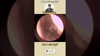 귀지형 콧물 부비동염 축농증 비염 코청소 이비인후과 rhinorrhea rhinitis sinusitis asmr ENT entdoctor [upl. by Naut]