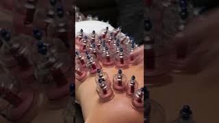 The Cupping Therapy an Ancient Treatment  InFact Tamil shortsvideo [upl. by Annair]