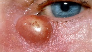 Lacrimal Abscess [upl. by Crowns]