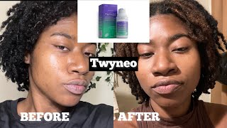 NEW Twyneo Tretinoin and Benzoyl Peroxide Review after 4 months Paulas Choice amp TruSkin for scars [upl. by Scarlett]