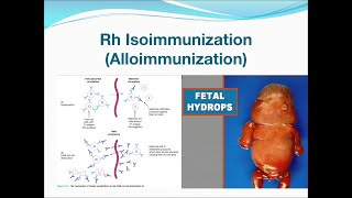 Rh Isoimmunization [upl. by Eisserc144]