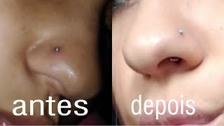 COMO ELIMINAR QUELOIDE DE PIERCING EM 2 DIAS [upl. by Venetia]