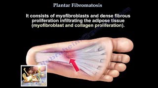 Plantar Fibromatosis  Everything You Need To Know  Dr Nabil Ebraheim [upl. by Rochette]