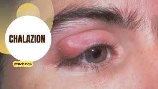 Chalazion swollen eyelid [upl. by Huntingdon360]