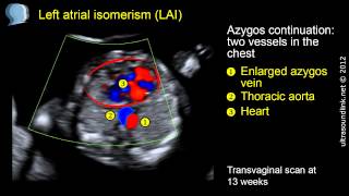 Left atrial isomerism with congenital heart block [upl. by Lael737]