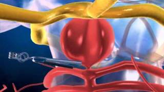 Aneurysm in the Brain and Clipping  3D medical animation  ABP © [upl. by Cirdek]