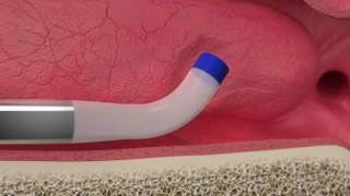 Acclarent AERA Eustachian Tube Dilation System with Audio [upl. by Eerbua]