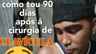 como é 90 dias após á cirurgia de clavícula [upl. by Tudela]