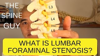 What is Lumbar Foraminal Stenosis [upl. by Oirramed265]