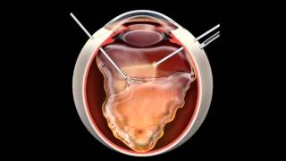 Retinal Detachment  Signs Symptoms and Treatment [upl. by Aerdnaek]