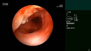 Tuberculosis  Endobronchial Stenosis  Bronchoscopic recanalisation [upl. by Glaudia]