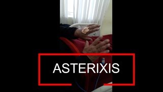 Asterixis  Flapping Tremor  Liver Flap [upl. by Jorge901]