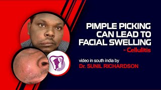 Pimple Picking can lead to facial swelling  cellulitis [upl. by Hen]