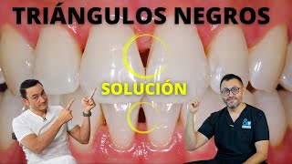 ¿Tienes huecostriángulos negros entre los dientes  Tratamiento y Causas [upl. by Kos]