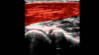 Musculoskeletal Ultrasound Elbow 1 anterior humeroradial longitudinal scan [upl. by Sanferd]