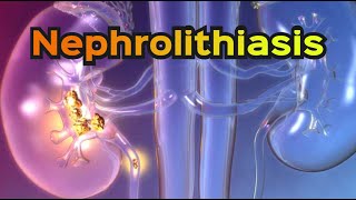 Nephrolithiasis Kidney Stones  CRASH Medical Review Series [upl. by Neerahs687]