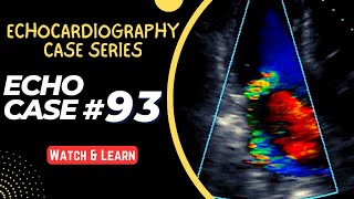 ECHO CASE 93  Echocardiography for Beginners  Echocardiogram Interpretation  2D Echo Basics [upl. by Eidnalem608]